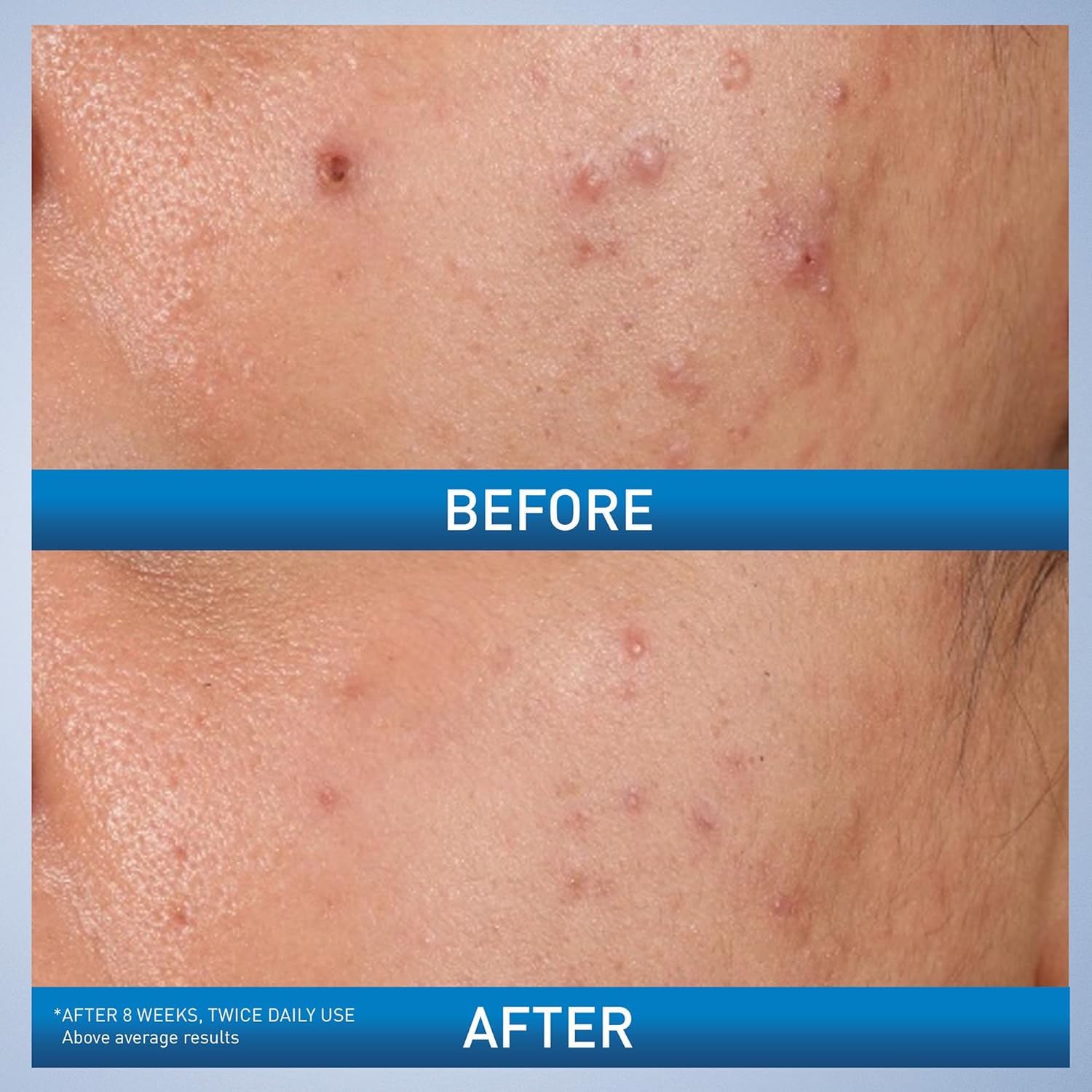 Cerave Acne Control Gel with AHA & BHA-40ml thumbnail 6